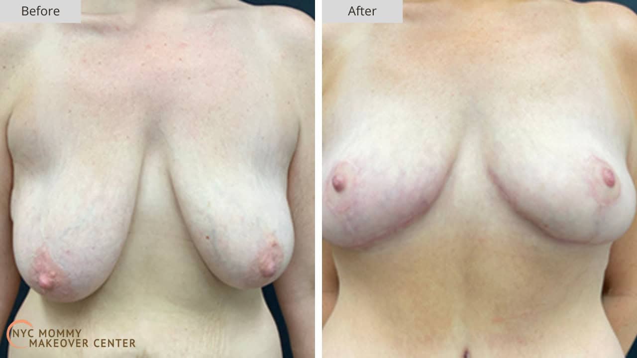 Mommy Makeover NYC Breast Lift Before and After #2a