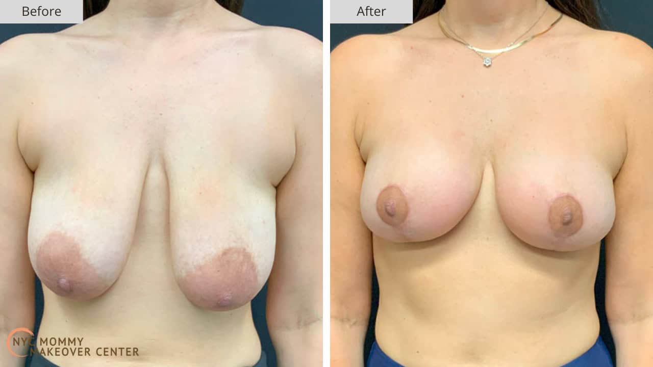 Mommy Makeover NYC Breast Lift Before and After #3a