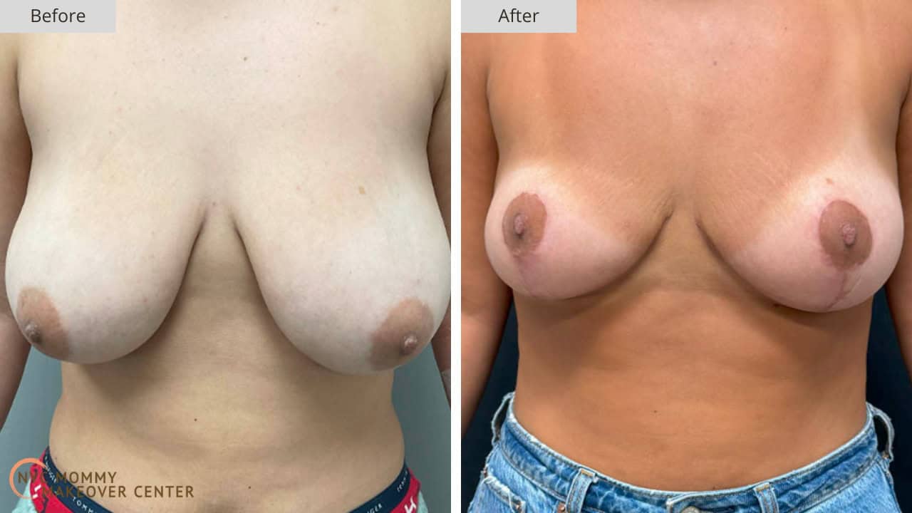 Mommy Makeover NYC Breast Lift Before and After #4a