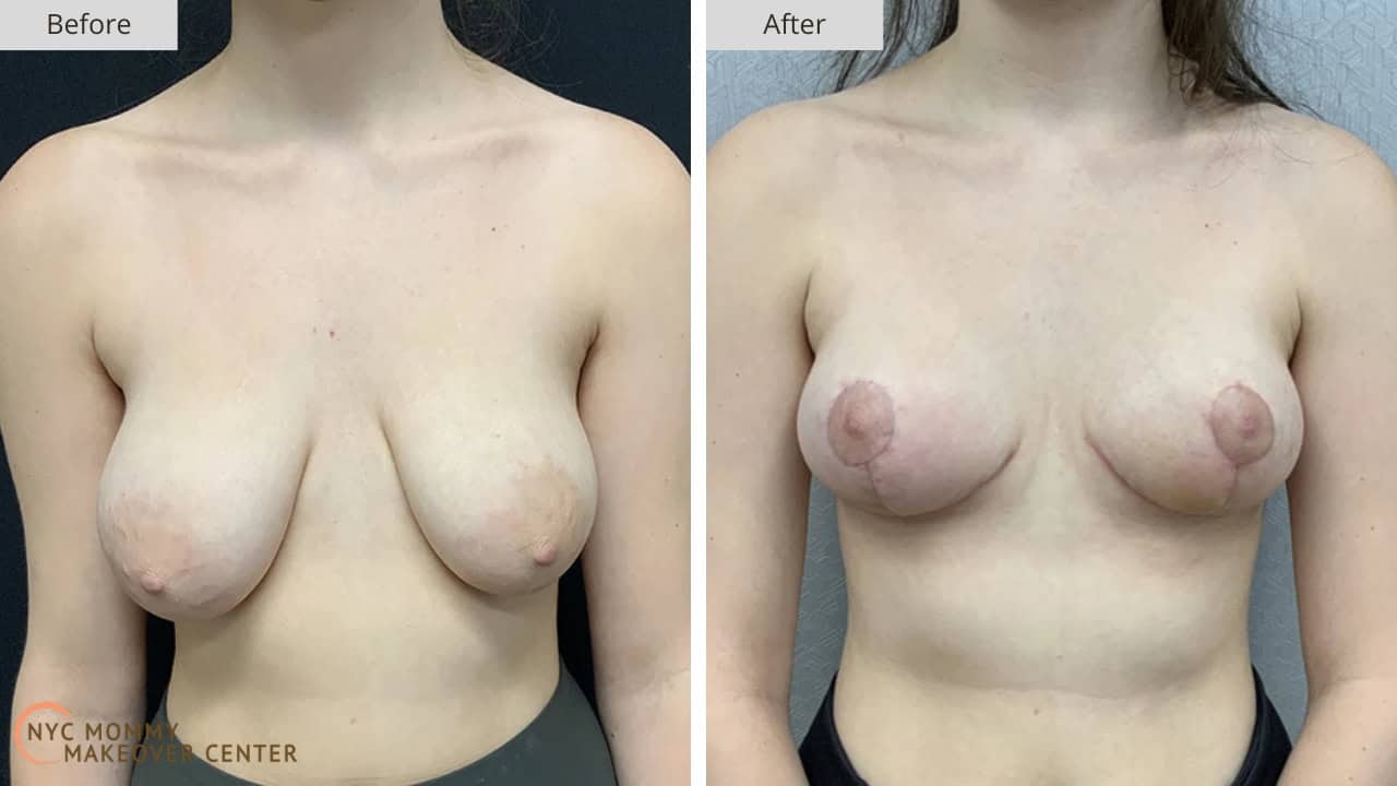 Mommy Makeover NYC Breast Lift Before and After #5a