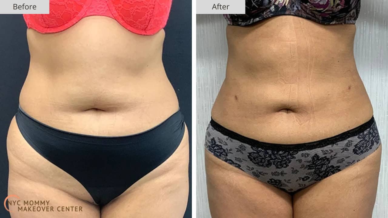 Mommy Makeover NYC Liposucton Before and After #1a