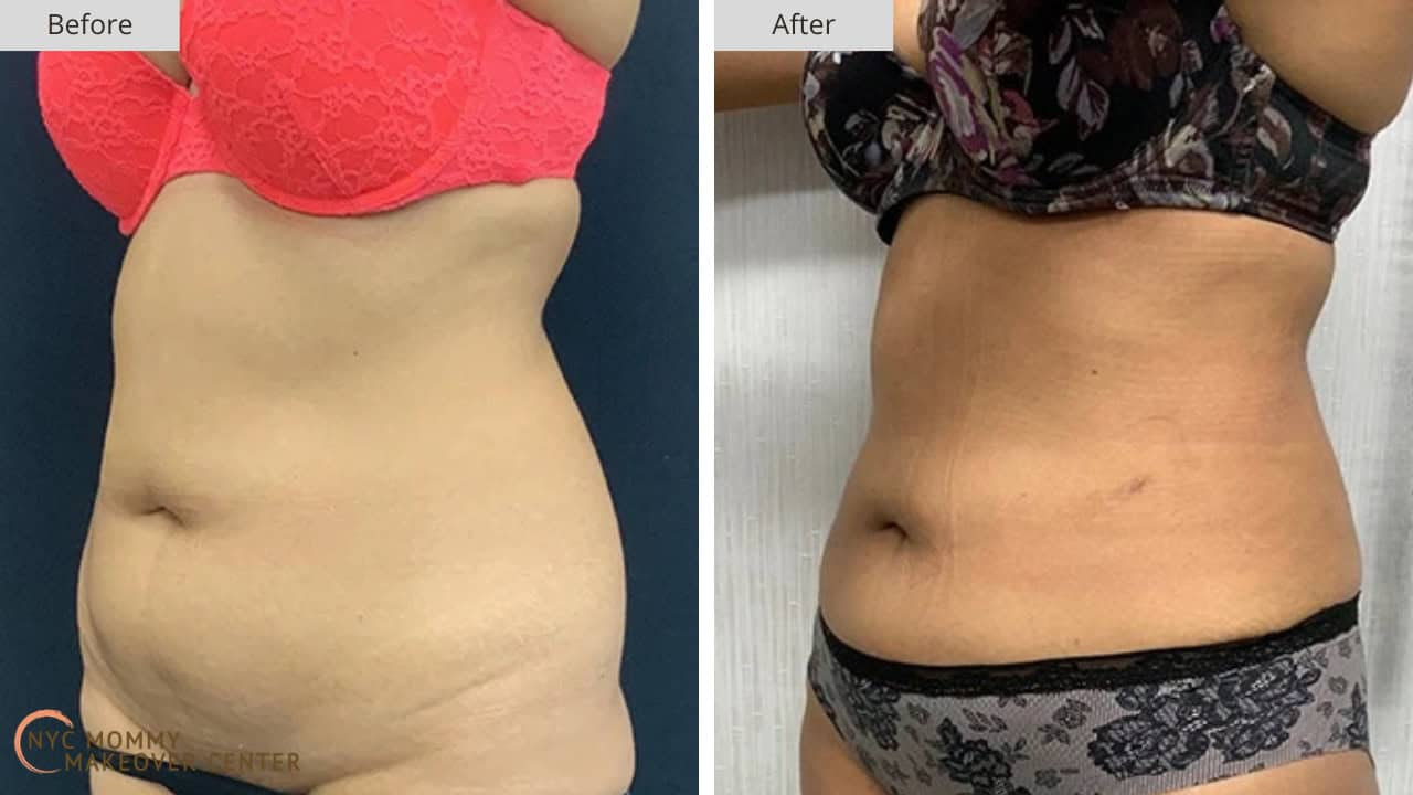 Mommy Makeover NYC Liposucton Before and After #1c