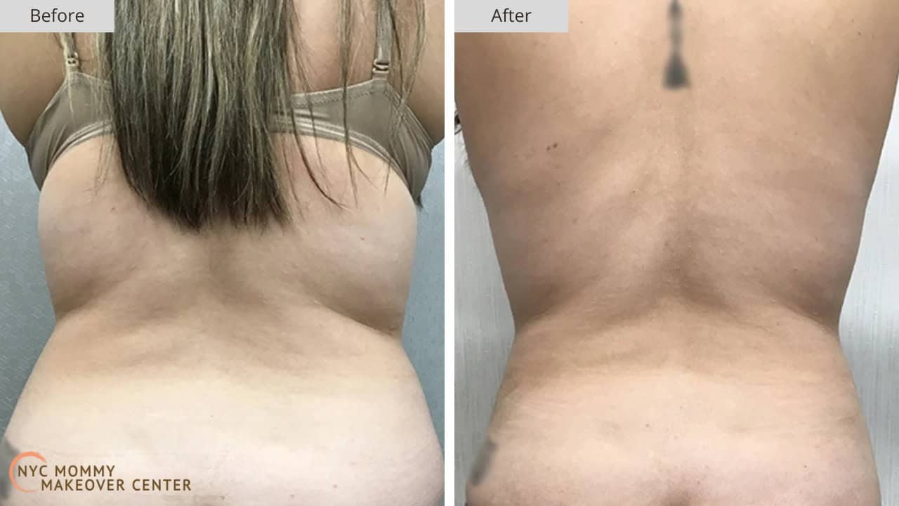 Mommy Makeover NYC Liposucton Before and After #2e