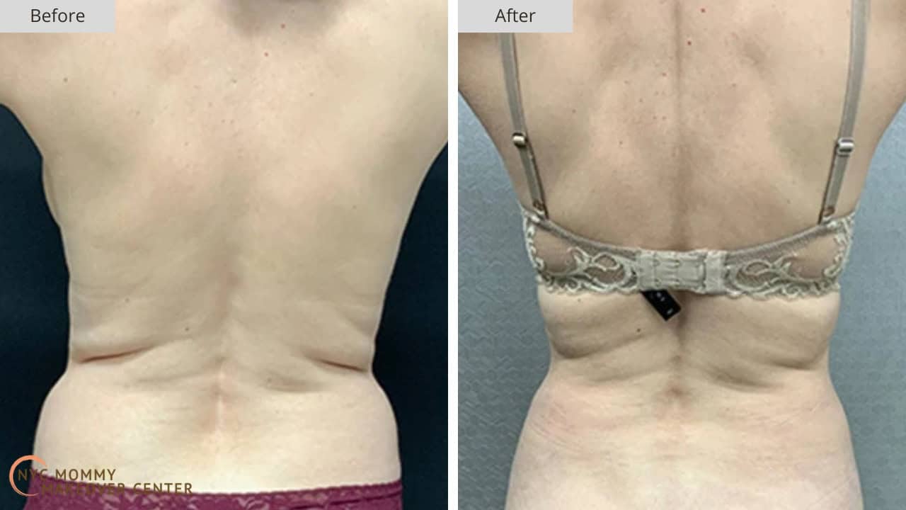 Mommy Makeover NYC Liposucton Before and After #4b