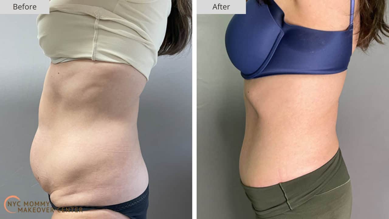Mommy Makeover NYC Tummy Tuck Before and After #36e
