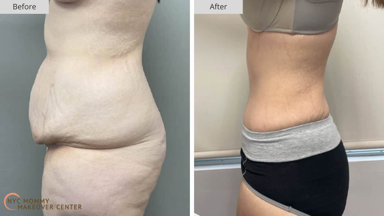 Mommy Makeover NYC Tummy Tuck Before and After #39c