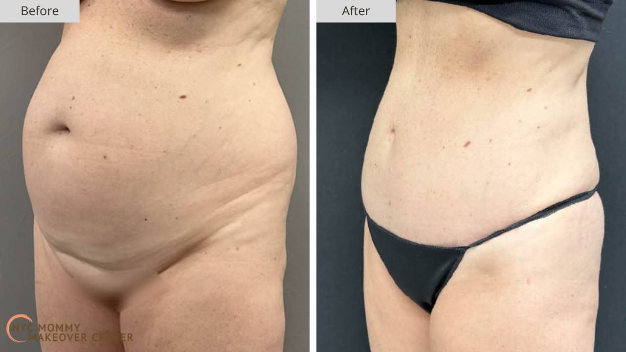 Mommy Makeover NYC Tummy Tuck Before and After #40c
