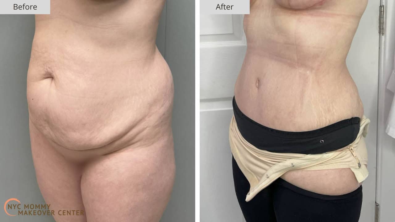 Mommy Makeover NYC Tummy Tuck Before and After #42c