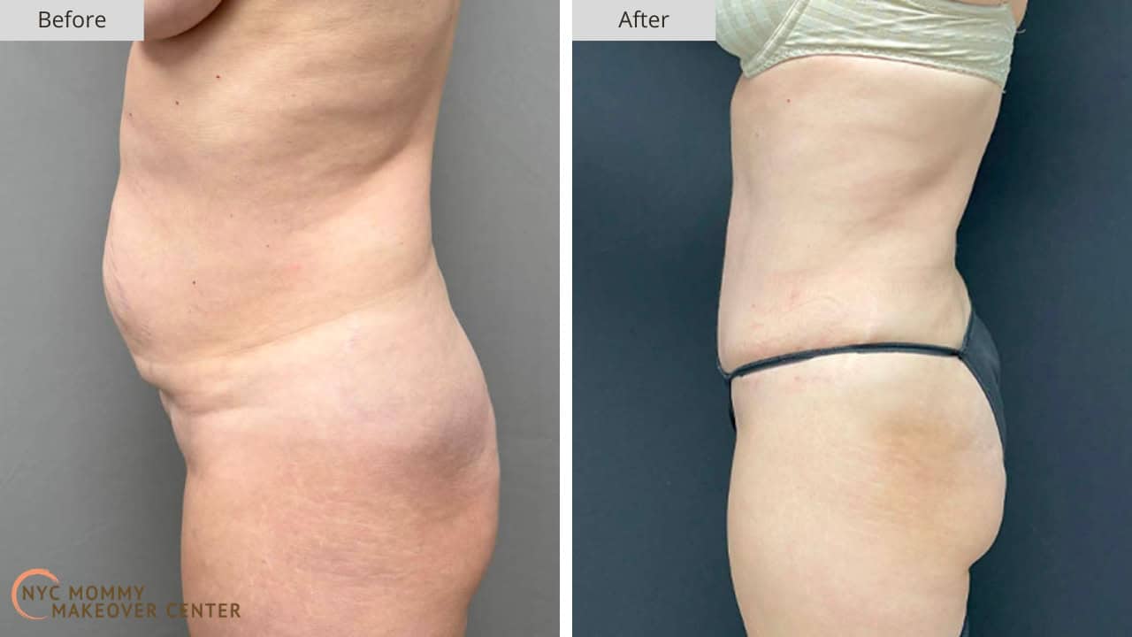 Mommy Makeover NYC Tummy Tuck Before and After #45b